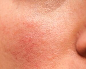 Peau au printemps : quels déséquilibres observer et comment ajuster sa routine ?